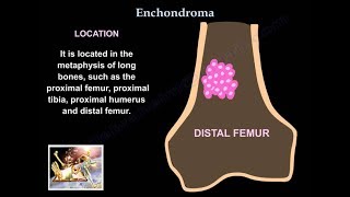 Enchondroma  Everything You Need To Know  Dr Nabil Ebraheim [upl. by Leila586]