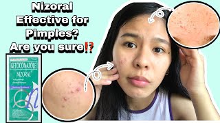 Nizoral ketoconazole honest review  Dandruff shampoo for fungal acne [upl. by Nigem]