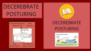 DECEREBRATE POSTUREAbnormal Posturing [upl. by Sharity178]