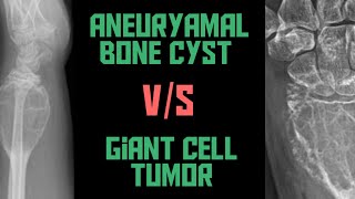 Benign Mixed Tumour of Salivary Gland  Pleomorphic Adenoma Histopathology [upl. by Anahsor]