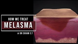 My 4Step Approach to Treating Melasma  Dr Chiam Chiak Teng [upl. by Ogilvy223]