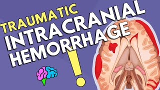 Intracranial Hemorrhage [upl. by Prentiss996]