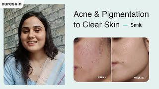 How Cureskin Helped Sanju Beat Acne Pigmentation amp Sunburn  Cureskin [upl. by Donald]