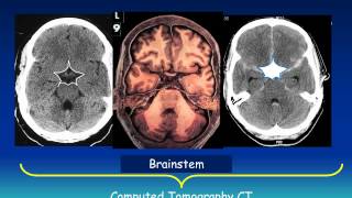 Ventricles of the Brain and CSF [upl. by Norehc]