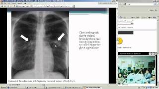 What is aspergillosis [upl. by Tunk]