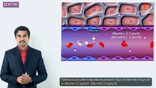 1Edema introduction  Hemodynamic pathology Fmge Neet PG and usmle [upl. by Kristina]