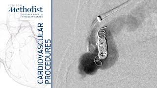 Transradial Prostate Artery Embolization PAE for Symptomatic BPH [upl. by Mohammad]