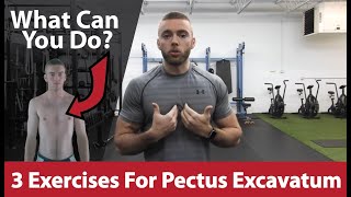 Pectus Excavatum Surgery What Should I Expect After Surgery [upl. by Pember]