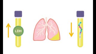 Differentiating transudative and exudative effusions transudate vs exudate [upl. by Ecikram803]