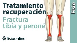 FRACTURA de TIBIA y PERONÉ Rehabilitación ejercicios y tiempo de recuperación [upl. by Killen]