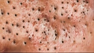 How To Remove Blackheads And Whiteheads On Face Easy 74 ✦ Dr Laelia ✦ [upl. by Alletsyrc682]