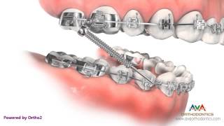 Orthodontic Treatment for Overjet Overbite  Forsus Appliance [upl. by Korb]