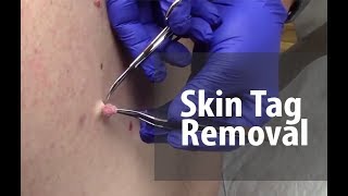 Skin Tag Removal  Dr Derm [upl. by Dahcir]