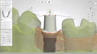 Customized abutment and a crown design [upl. by Ajnotal]