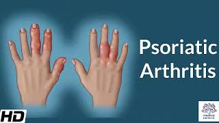 Psoriatic Arthritis  Everything You Need To Know  Dr Nabil Ebraheim [upl. by Sivla871]