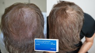 My Finasteride Results After 1 Year [upl. by Lilybelle]