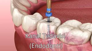 Kanal Tedavisi  Endodonti [upl. by Hess]