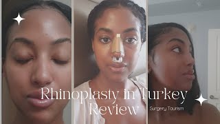 Rhinoplasty in Turkey Review [upl. by Barnabas]