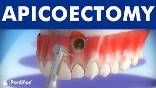 Apicoectomy  Treatment of root canal infection © [upl. by Pihc]