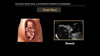 The Basic Fetal Heart Scan [upl. by Pandolfi]