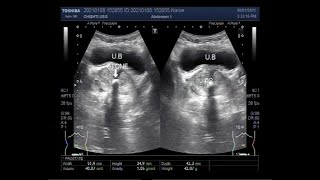 Prostatic utricle cyst or utricular cyst PUC and a Stone in the prostatic urethra with BPH [upl. by Adnirod386]