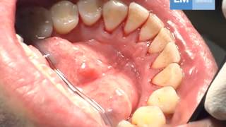 Periodontal treatment protocol [upl. by Assirk]