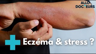 Eczéma  quelles solutions   Allo Docteurs [upl. by Ailaro]