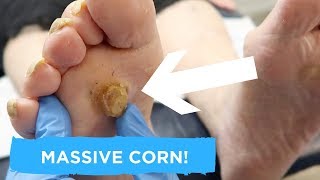 MASSIVE CORN TREATMENT [upl. by Aligna155]