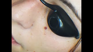 Laser Treatment of Cherry Angiomas [upl. by Saito695]