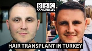 Hair Transplant Turkey  BBC Documentary  Paul Before amp After [upl. by Kafka854]