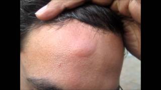 Head Injury Bump Home Treatment [upl. by Zel]