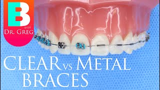 Clear Braces vs Metal Braces [upl. by Alaekim]