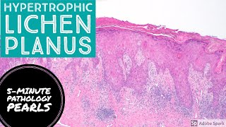 Hypertrophic Lichen Planus 5Minute Pathology Pearls [upl. by Jessee759]