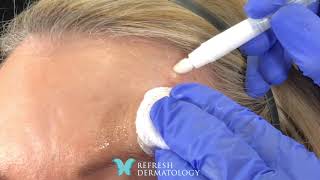 Eskata Live Demonstration to remove a Seborrheic Keratosis [upl. by Dumanian]