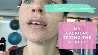 MY EXPERIENCE  Vi Peel For Hyperpigmentation Melasma [upl. by Centonze]