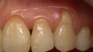 Treatment of Gum RecessionConnective Tissue Graft and Alloderm [upl. by Cati187]