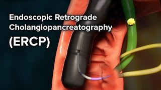 upper gastrointestinal endoscopy procedure [upl. by Burkitt]