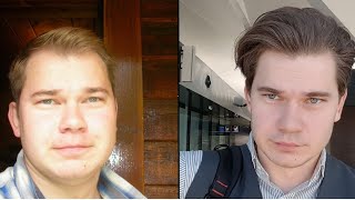 Truth About Finasteride My 12 Year Update Results [upl. by Younglove]