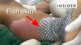 Doctors Are Using Fish Skin to Treat Burns [upl. by Ahsiri]