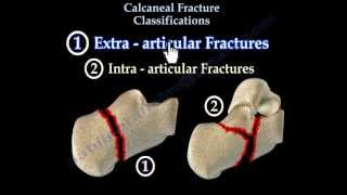 Calcaneal Fracture Classifications  Everything You Need To Know  Dr Nabil Ebraheim [upl. by Akilegna862]