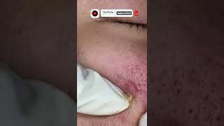 Cystic acne and blackheads removal  Newest pimple pops for 2022 [upl. by Pennington991]