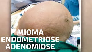 Qual a diferença entre endometriose mioma e adenomiose [upl. by Eiralav]