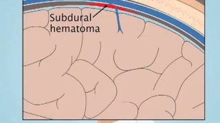 Understanding Subdural Hematoma [upl. by Anirahs]