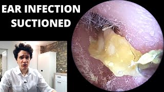 Pus and Dead Skin Suctioned From Ear Canal Acute Otitis Externa [upl. by Jeritah]