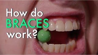 How Do Braces Work [upl. by Oswal]