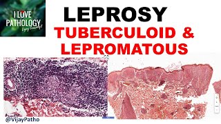 LEPROSY etiopathogenesis classification Tuberculoid amp lepromatous leprosy [upl. by Ludwog]