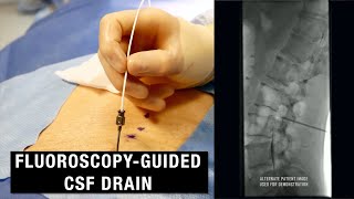 FluoroscopyGuided CSF Drain Spinal Drain  Demo and Anatomy Review [upl. by Francklyn]