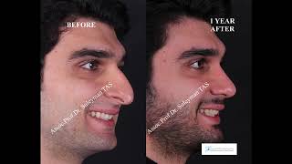 Male Rhinoplasty in Turkey [upl. by Ahseim703]