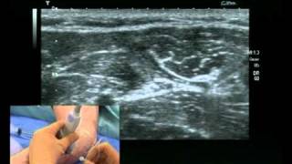 Ulnar nerve block ultrasound guided [upl. by Dercy786]