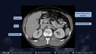 TOMOGRAFIA AXIAL BASICA DE ABDOMEN Y PELVIS [upl. by Sulakcin795]